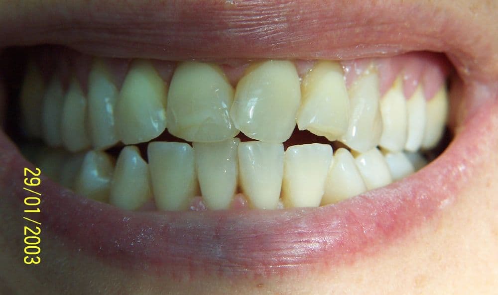 Sourire avant traitement esthétique, cas 1