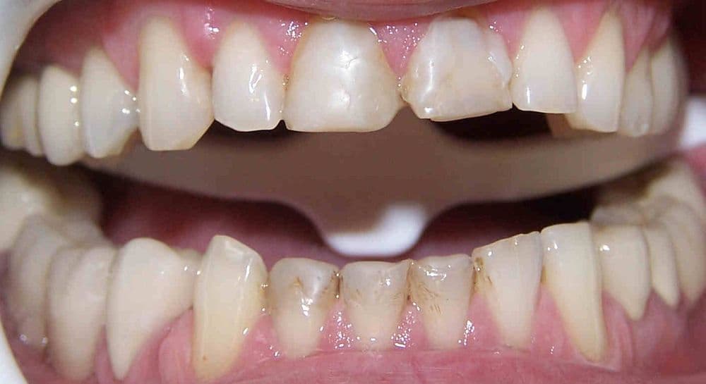 Sourire avant traitement esthétique, cas 2